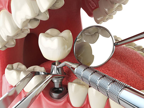 Best Emergency Root Canal Treatment in Blakely, PA